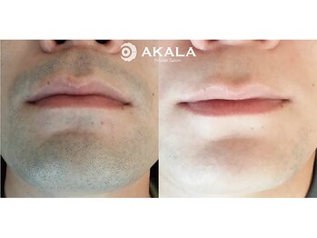 メンズ脱毛サロン アカラ(AKALA)/ヒゲ脱毛のビフォーアフター
