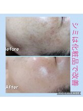 フリージア(Beauty Salon Freesia )/シミケアに特化した化粧品使用