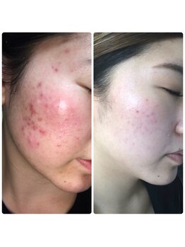 ツヤハダコガオ 千葉店/before⇒afterハーブピーリング