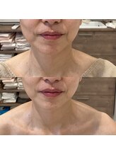 ビューティーサロン セガール(segar)/レッドショットフェイス