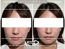 ユウサク(Yusaku)/30代症例【小顔矯正/本町/梅田】