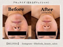 ベリンダ(BELINDA)の雰囲気（引き上げフェイシャルエステ《アキュライズ》リピート率◎）