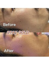 ステイゴールド 新百合ヶ丘(STAY GOLD)/角質フェイシャル