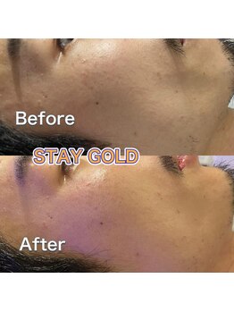 ステイゴールド 新百合ヶ丘(STAY GOLD)/角質フェイシャル