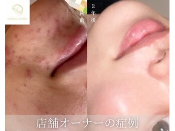 ウルワシ(Uruwashi)/ハーバルモアハーブピーリング