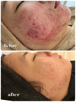 カラン(CALIN)/グリーンハーブピーリング