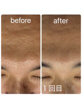 スキンラボ カホクカイ(KaHokuKai)/初回