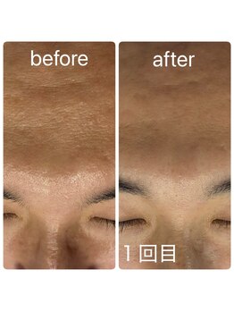 スキンラボ カホクカイ(KaHokuKai)/初回