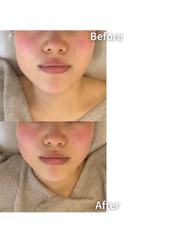 エムボーテ 太田店(M BEAUTE33)/顔筋小顔コルギ