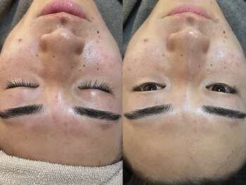 ビーマジック(Be Magic)/1回の施術でこの変化!