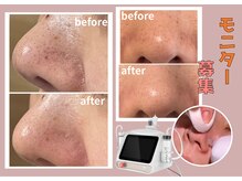 プラム(plum)の雰囲気（【モニター募集】東海地区初上陸！最新毛穴マシンでつるん鼻に。）