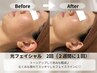 光フェイシャル | リフトアップ効果♪ シミ・ニキビにも　¥11,000→¥5,500