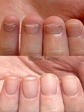 マリーロール 梅田店(Marie Laure)/自爪育成/深爪矯正/ネイルケア