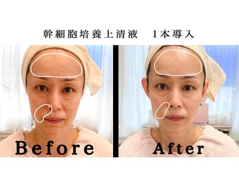 ティアランジュ 米子店(Tiarange)/GROTTY PRO 幹細胞培養液導入