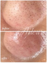 エルール トータルビューティ(Aileure total beauty)/Waxフェイシャル