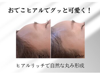 アールメディカルサロン 富山院(R Medical Salon)/丸いおでこヒアルで可愛らしさUP