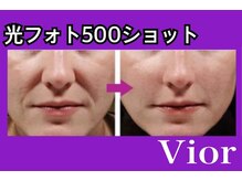 ヴィオール 名古屋栄店(VIOR)/【大人気】小顔 光ショット施術