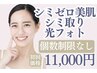 【シミケア人気NO.1】美肌シミ改善特許マシンで光フォト打ち放題11,000円