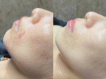 エモーショナル 姫路(Emotional)/肌トラブルに負けない肌へ！