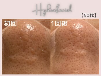 美シェリ(美Cheri)/ハイドラビフォーアフター