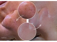 プアマヌ(PUA MANU)/イチゴ鼻/鼻のザラつき/毛穴ケア