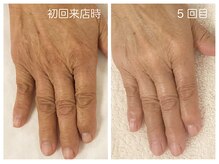 キレイテ 上野店/60代/5回目【ハンドケア上野】
