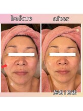 プリマジュール/「しわ」「たるみ」ケア後写真