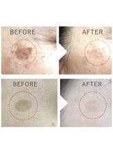 プランス 渋谷(PLANCE)/毛穴/ハーブ/ニキビケア