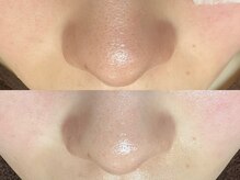 エクラ バイ シャンリィ(eclat by shanLy)/毛穴洗浄