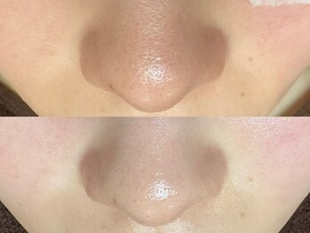 エクラ バイ シャンリィ(eclat by shanLy)/毛穴洗浄