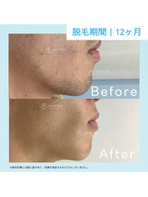 メンズクリア 武蔵小杉店/【メンズクリア】お客様の施術例