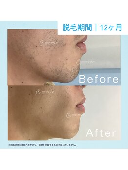 メンズクリア 武蔵小杉店/【メンズクリア】お客様の施術例