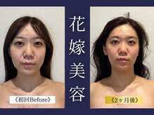 エレミュー 烏丸(Elemue.)/20代前半　6回《たるみ改善》