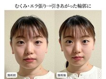 ドリームスパ 武蔵小杉店(DREAM SPA)/小顔before→after