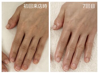キレイテ 福岡天神店/ゴツゴツ感と関節の黒ずみ