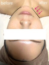 リフト 北千住(Lift)/オンダリフト/Before/After