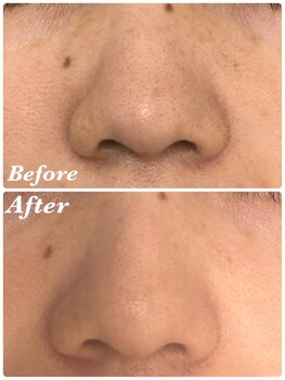 ライフ美容整体院 恵比寿(Life美容整体院)/ララピール×毛穴洗浄