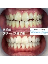 ホワイトニングサロン 熊本店/歯に自信が持てるホワイトニング
