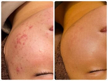 ハーブピーリング 恵比寿/ハーブピーリングbefore→after