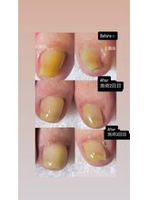 アールネイルズ(R Nails)/巻き爪ケア