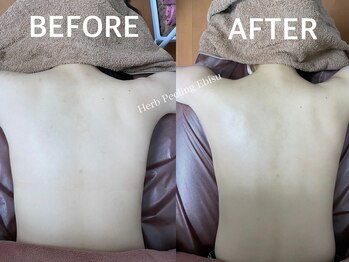 ハーブピーリング 恵比寿/背中引締ハーブピーリング