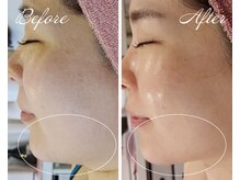 最新美容液でたるみケア