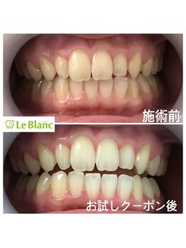 ルブラン 奈良店(Le Blanc)/お得なクーポンで白く！