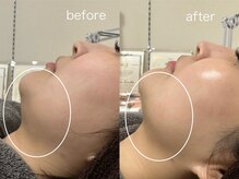 パールフェイスエステ ルペルル(PEARL FACE ESTHE la perle)の雰囲気（EMSと超音波で深層から引き上げ&たるみ改善！小顔効果！）