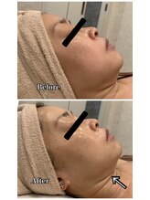 ブランシュール/小顔タイト×エンビロン