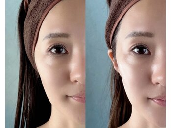 シンボディメイク 恵比寿(SiN BODY MAKE)/幹細胞注入フェイシャル