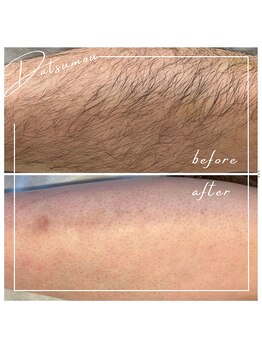 テンポフェリーチェ 浜松店(Tempo Felice)/浜松脱毛/都度払い/メンズ脱毛