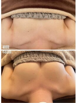 美人バスト 新宿店/☆姉妹店バストアップ症例写真☆