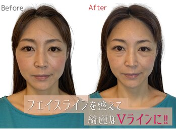 小顔製作所 心斎橋院/小顔矯正　施術実例１