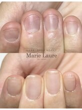 マリーロール 天王寺店(Marie Laure)/自爪育成/深爪矯正/ネイルケア